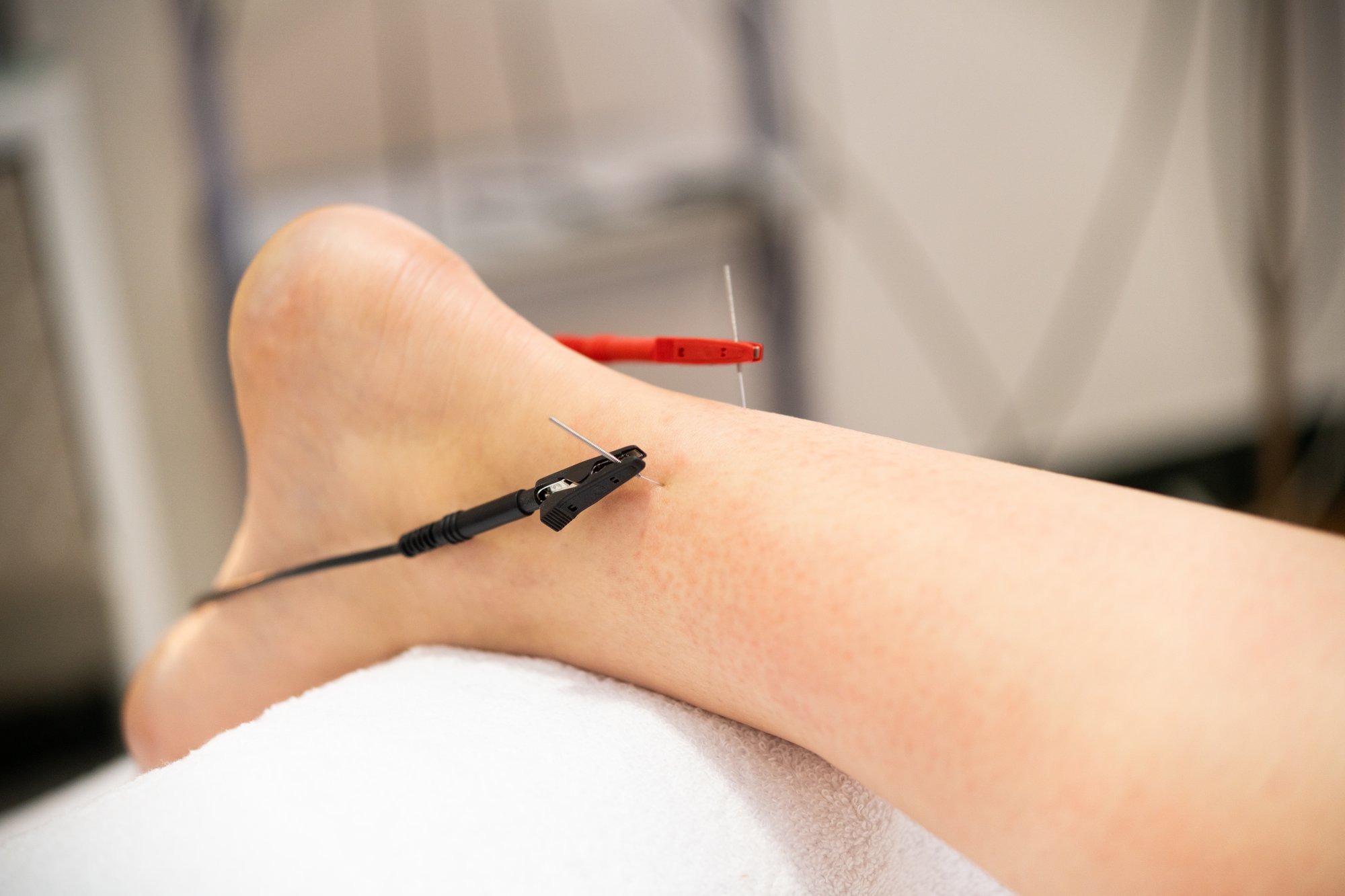 electro-acupuncture-dry-with-needle-connecting-mac-2025-03-25-11-35-59-utc