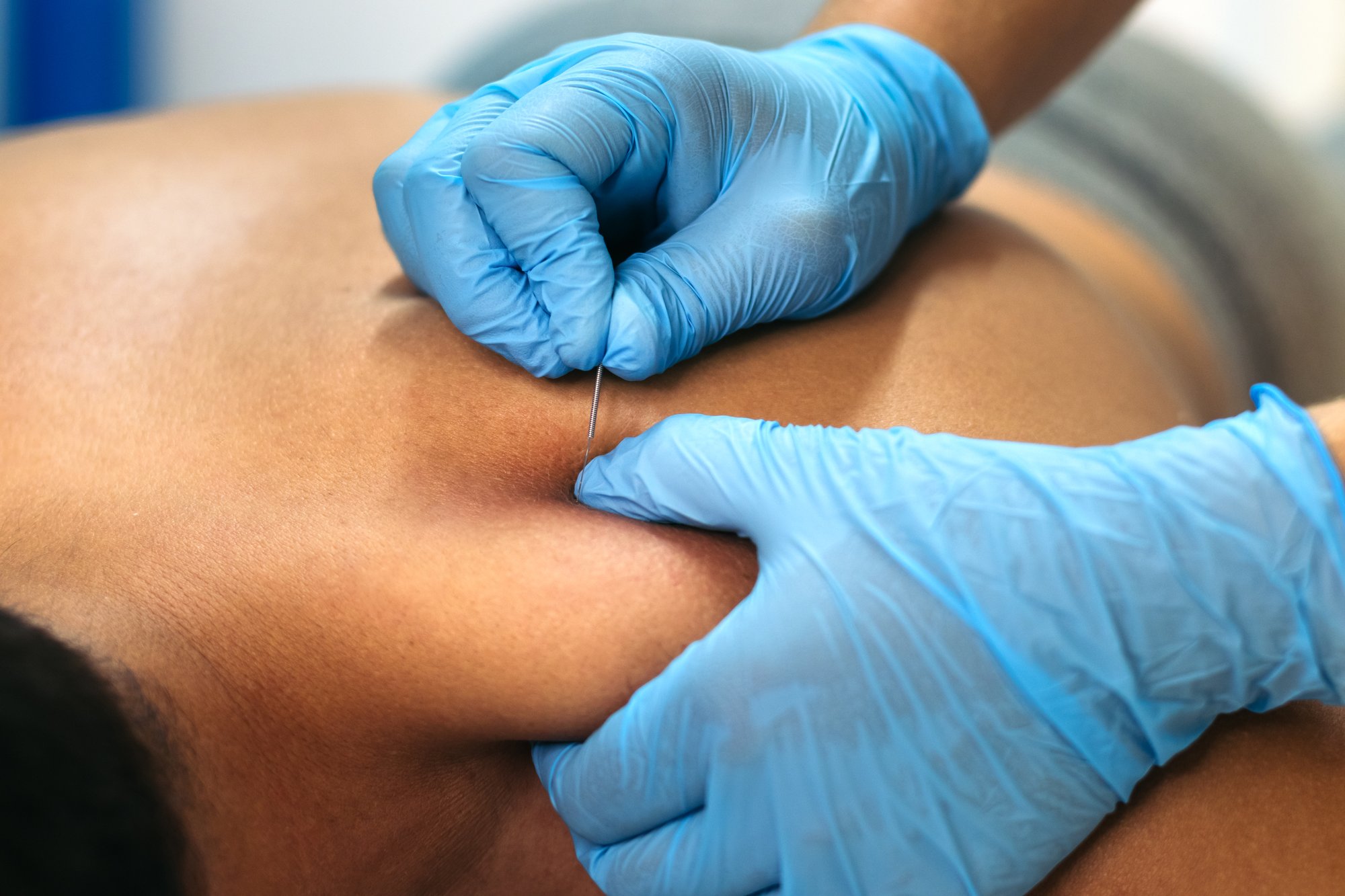 physiotherapy-clinic-dry-needling-2025-03-23-18-41-10-utc